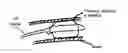 Fig. 01 - Low Force Thrombectomy Device