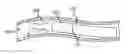 Fig. 01 - Catheter electrode assembly