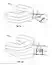 Fig. 08 - Methods and materials for oral stenting