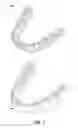 Fig. 02 - Tabbed dental appliance