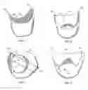 Fig. 03 - Method and apparatus for recording spatial gingival soft tissue relationship to implant placement within alveolar bone for immediate-implant placement