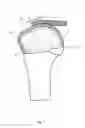 Fig. 02 - Arthroscopic Method and Apparatus for Rotator Cuff Repair