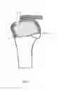 Fig. 04 - Arthroscopic Method and Apparatus for Rotator Cuff Repair