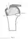 Fig. 06 - Arthroscopic Method and Apparatus for Rotator Cuff Repair