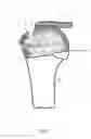 Fig. 07 - Arthroscopic Method and Apparatus for Rotator Cuff Repair