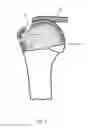 Fig. 08 - Arthroscopic Method and Apparatus for Rotator Cuff Repair