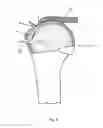Fig. 09 - Arthroscopic Method and Apparatus for Rotator Cuff Repair