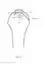 Fig. 22 - Arthroscopic Method and Apparatus for Rotator Cuff Repair