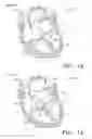 Fig. 02 - Reinforced Prosthetic Tissue Valves