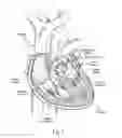 Fig. 02 - Devices, systems, and methods for reshaping a heart valve annulus, including the use of a bridge implant having an adjustable bridge stop