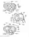 Fig. 03 - Devices, systems, and methods for reshaping a heart valve annulus, including the use of a bridge implant having an adjustable bridge stop