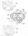 Fig. 05 - Devices, systems, and methods for reshaping a heart valve annulus, including the use of a bridge implant having an adjustable bridge stop