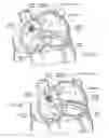 Fig. 06 - Devices, systems, and methods for reshaping a heart valve annulus, including the use of a bridge implant having an adjustable bridge stop