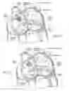 Fig. 07 - Devices, systems, and methods for reshaping a heart valve annulus, including the use of a bridge implant having an adjustable bridge stop