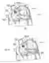 Fig. 12 - Devices, systems, and methods for reshaping a heart valve annulus, including the use of a bridge implant having an adjustable bridge stop
