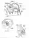 Fig. 14 - Devices, systems, and methods for reshaping a heart valve annulus, including the use of a bridge implant having an adjustable bridge stop