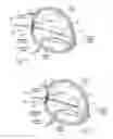 Fig. 34 - Devices, systems, and methods for reshaping a heart valve annulus, including the use of a bridge implant having an adjustable bridge stop