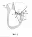 Fig. 06 - Valve prosthesis and method for delivery