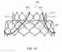 Fig. 07 - Valve prosthesis and method for delivery