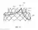 Fig. 08 - Valve prosthesis and method for delivery