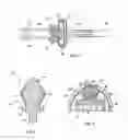 Fig. 02 - Percutaneous implant