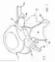 Fig. 02 - Prosthesis for the replacement of a posterior element of a vertebra