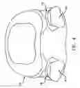 Fig. 05 - Prosthesis for the replacement of a posterior element of a vertebra