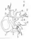 Fig. 16 - Prosthesis for the replacement of a posterior element of a vertebra