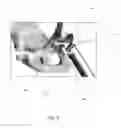 Fig. 09 - APPARATUS AND METHOD FOR POSITIONING OF ACETABULAR COMPONENTS DURING HIP ARTHROPLASTY PROCEDURES