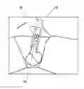 Fig. 01 - Erection simulator prosthsesis