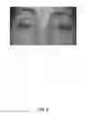 Fig. 07 - APERTURE WIDENING PROSTHESIS INCLUDING SPLINE SURFACE TOPOGRAPHY AND METHODS OF MAKING THE SAME