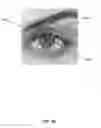 Fig. 49 - APERTURE WIDENING PROSTHESIS INCLUDING SPLINE SURFACE TOPOGRAPHY AND METHODS OF MAKING THE SAME