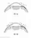 Fig. 07 - Shunt placement through the sclera