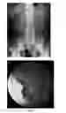 Fig. 02 - Enterically coated cysteamine, cystamine and derivatives thereof