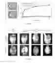 Fig. 06 - Materials and methods useful for treating glioblastorna