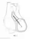 Fig. 04 - Sensors for catheter pumps