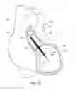 Fig. 22 - Sensors for catheter pumps