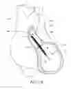 Fig. 25 - Sensors for catheter pumps