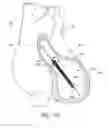Fig. 26 - Sensors for catheter pumps