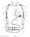 Fig. 02 - Methods for upgrading ventricle assist devices