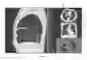 Fig. 06 - Visualization and characterization of pulmonary lobar fissures