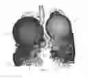 Fig. 08 - Visualization and characterization of pulmonary lobar fissures