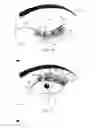 Fig. 09 - Method of applying artificial eyelashes to an eyelid and an assembly therefor