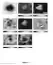 Fig. 08 - Optical transfer diagnosis (OTD) method for discriminating between malignant and benign tissue lesions