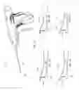Fig. 02 - Suture passers adapted for use in constrained regions