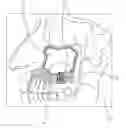Fig. 01 - Sinus implant