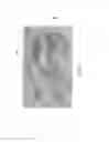 Fig. 30 - Anatomically adapted orthopedic implant and method of manufacturing same