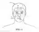 Fig. 02 - Intranasal medication delivery device and method of use thereof