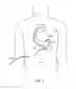 Fig. 02 - Ventricular assist blood pump