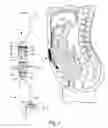 Fig. 02 - Implantable bioartificial perfusion system